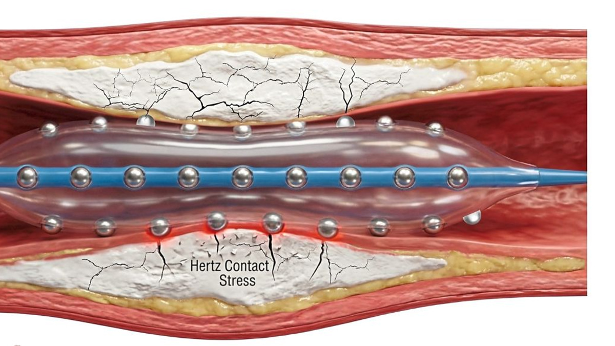 Malaysian Cardiologists Pioneer Advanced Technique for Hardened Heart Artery Disease
