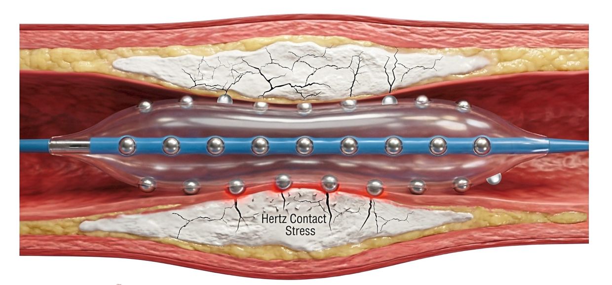 Malaysian Cardiologists Pioneer Advanced Technique for Hardened Heart Artery Disease